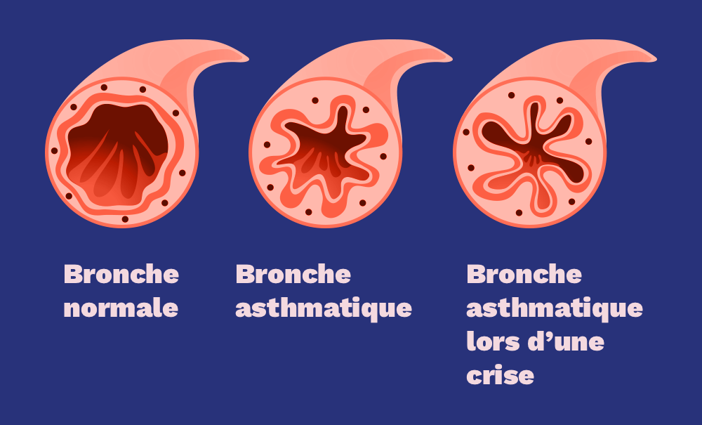 L Asthme Ma Trise De Concept Inf De Poche